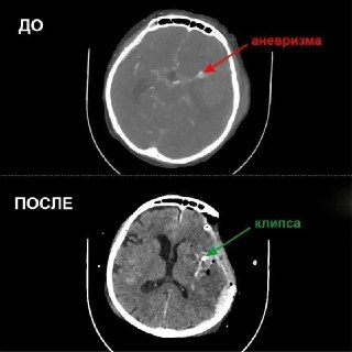 Врачи Новокузнецка спасли жизнь женщине с опасной аневризмой